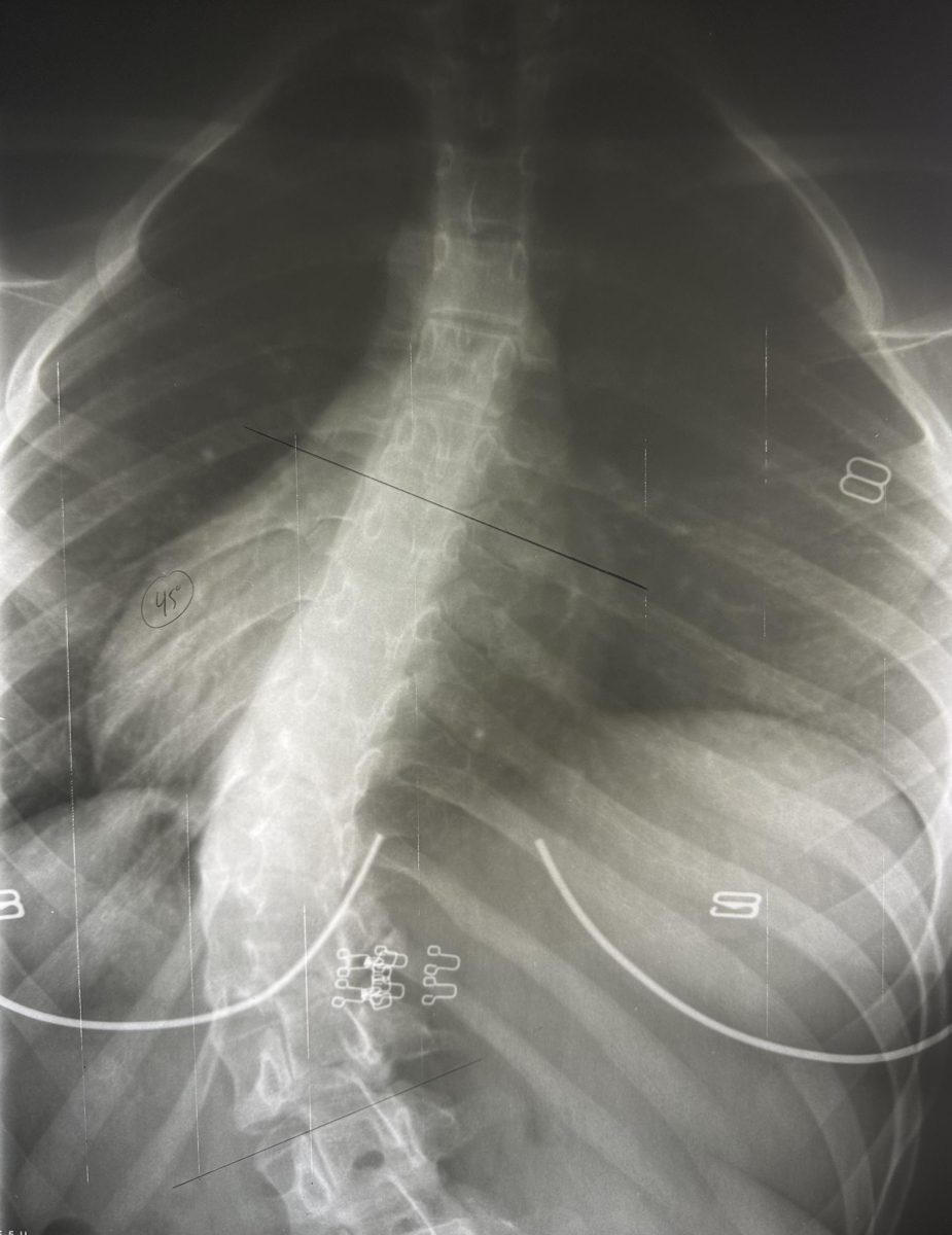 Ireland Kopsch's orginal X-ray of her thoracic left curvature of the spine, also known as scoliosis.